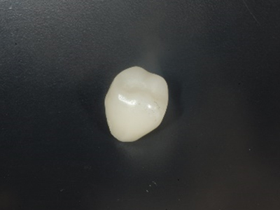 白い歯の治療 即日治療