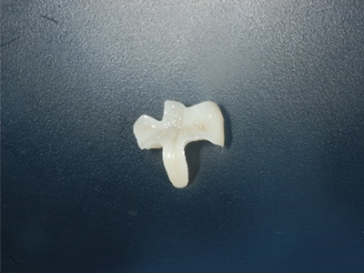 白い歯の治療 即日治療