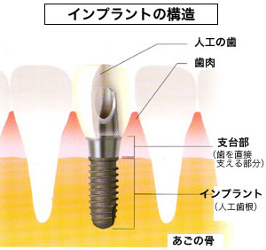 インプラント