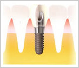 インプラント
