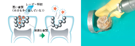 殺菌して虫歯を取る治療