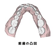 前歯の凸凹