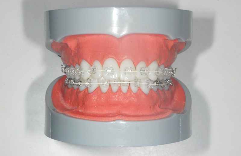 歯並びの治療