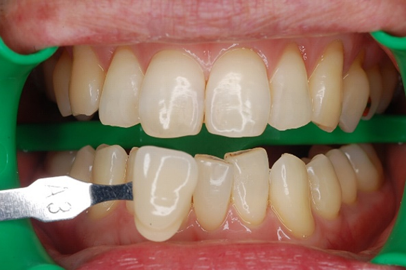 白い歯の治療 ホワイトニング