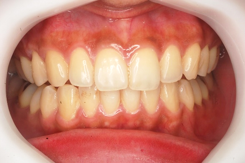 白い歯の治療 ホワイトニング